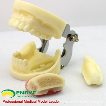IMPLANT06(12617) имплантат практика модель челюсти с нижней челюсти для Закрылков и практика бурения
